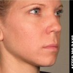 Ultherapy Before & After Patient #1549